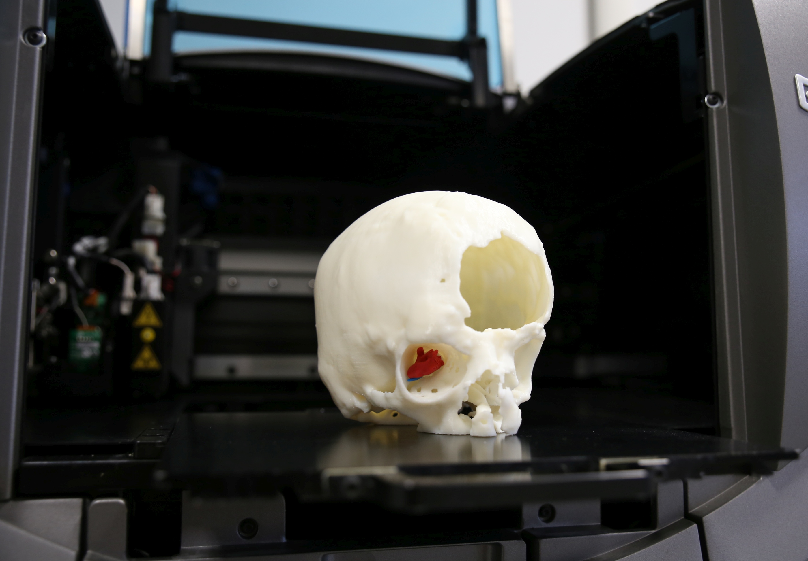 un modello di stampa 3d con la riproduzione della massa tumorale asportata